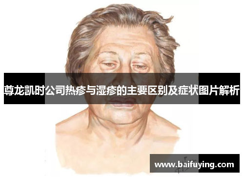 尊龙凯时公司热疹与湿疹的主要区别及症状图片解析
