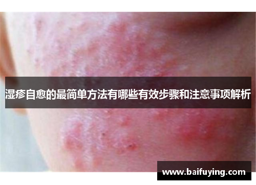 湿疹自愈的最简单方法有哪些有效步骤和注意事项解析